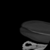 SPORK, NICO - 22.03.1976 - 02.08.2022 - CT obere Extremität - 17:59:38
